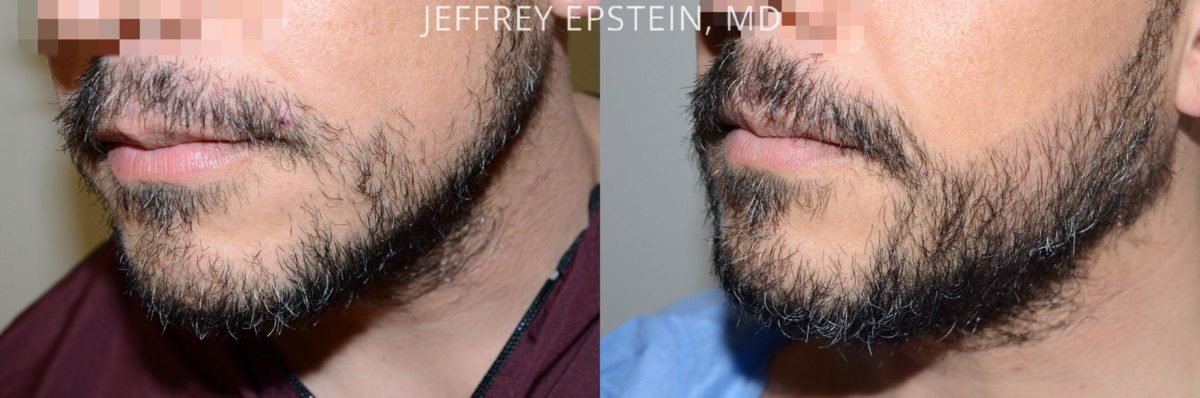 Facial Hair Before and after in Miami, FL, Paciente 57708