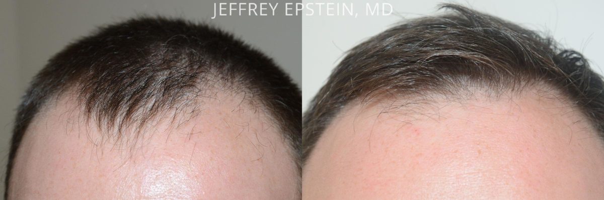 Hair Transplants for Men Before and after in Miami, FL, Paciente 57769