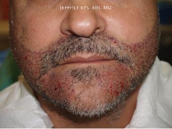Facial Hair Transplant Before and after in Miami, FL, Paciente 35133