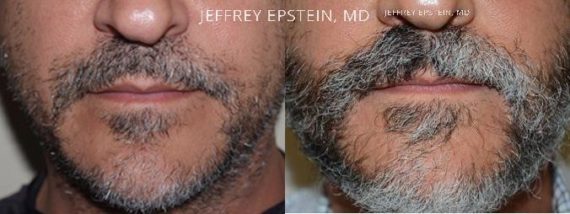 Trasplante de Pelo Facial Before and after in Miami, FL, Paciente 73847