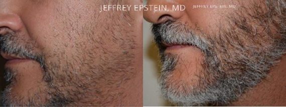 Trasplante de Pelo Facial Before and after in Miami, FL, Paciente 73847