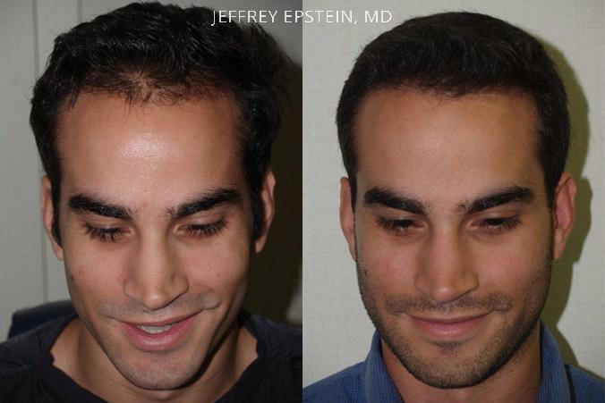 Trasplante de Pelo en Hombres Antes y después en Miami, FL, Paciente 90397