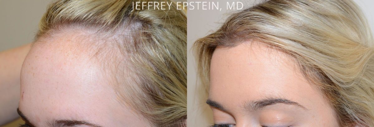 Hairline Advancement Before and after in Miami, FL, Paciente 54163
