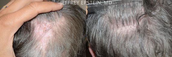 Donor Site Transplant Close Ups Before and after in Miami, FL, Paciente 57761