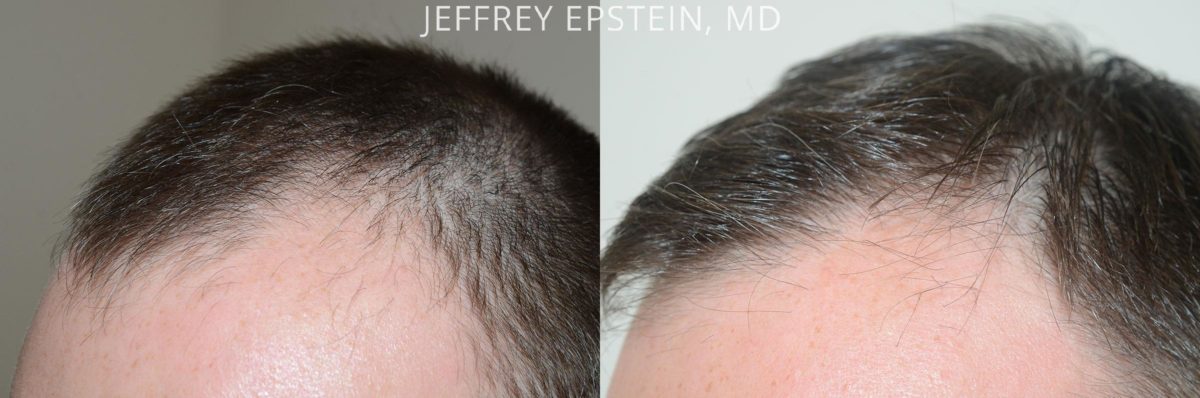 Hair Transplants for Men Before and after in Miami, FL, Paciente 57769