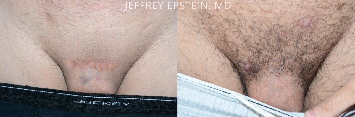 Body Hair Transplant Before and after in Miami, FL, Paciente 57953