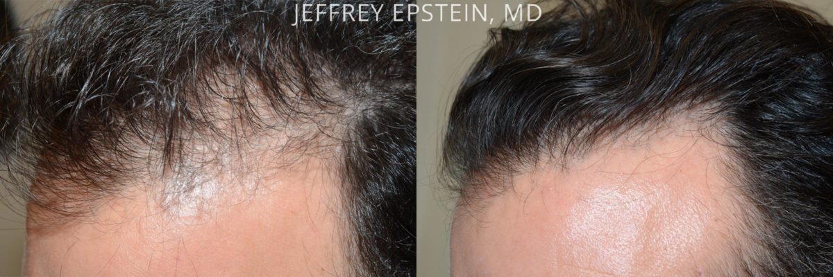 Hair Transplants for Men Before and after in Miami, FL, Paciente 57901