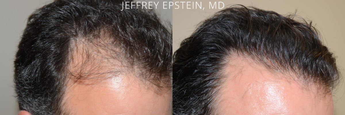 Hair Transplants for Men Before and after in Miami, FL, Paciente 57901