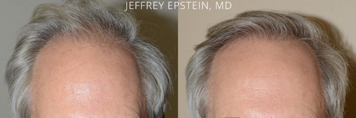 Hair Transplants for Men Before and after in Miami, FL, Paciente 57979