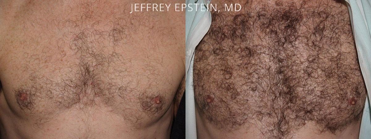 Body Hair Transplant Before and after in Miami, FL, Paciente 35060