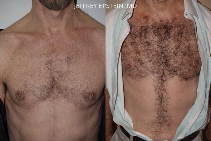 Body Hair Transplant Before and after in Miami, FL, Paciente 35060