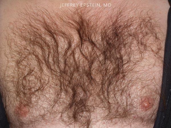 Body Hair Transplant Before and after in Miami, FL, Paciente 35094