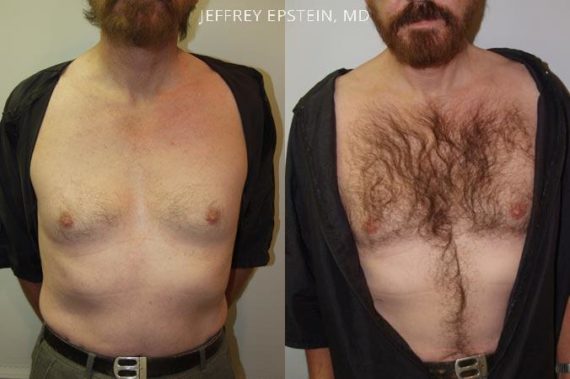 Body Hair Before and after in Miami, FL, Paciente 35094