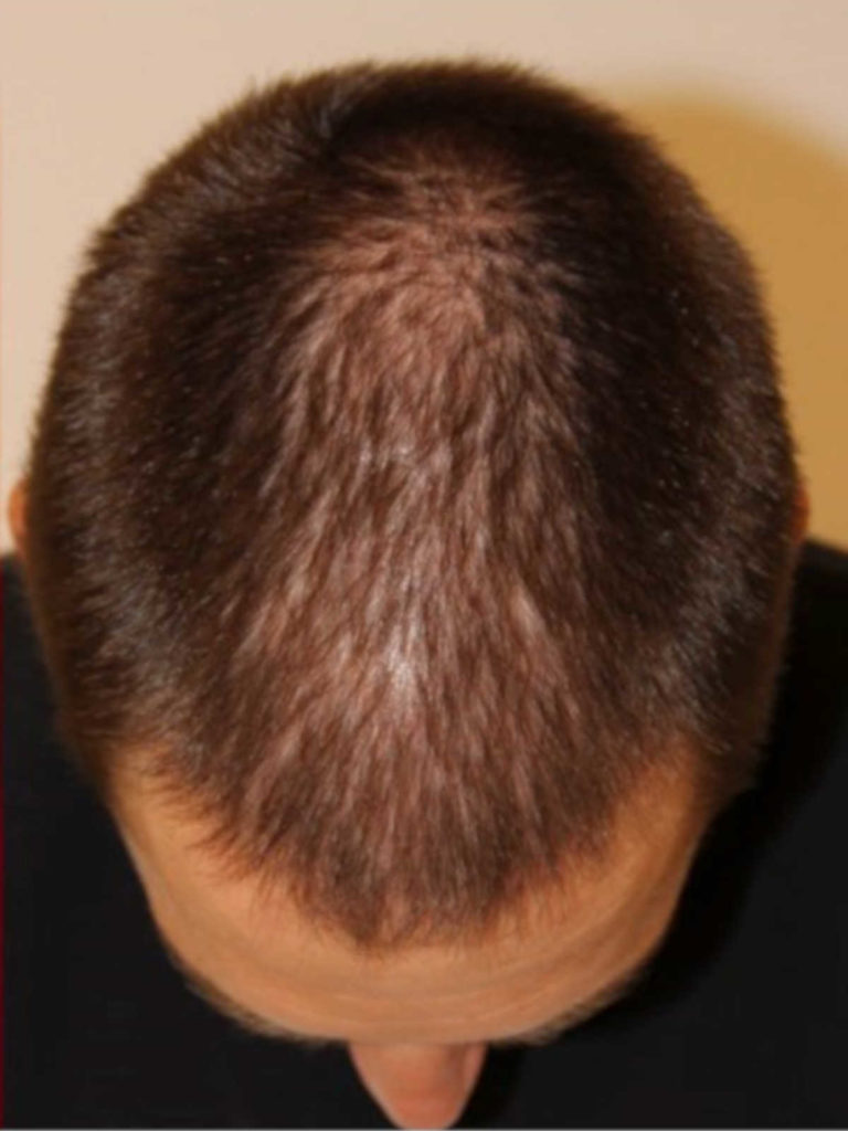 Paciente de pérdida de cabello de patrón masculino - Foto de Después