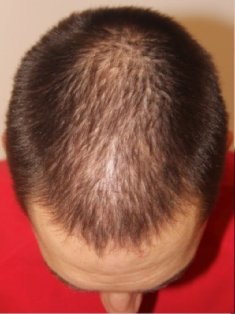 Paciente de pérdida de cabello de patrón masculino - Foto de Antes
