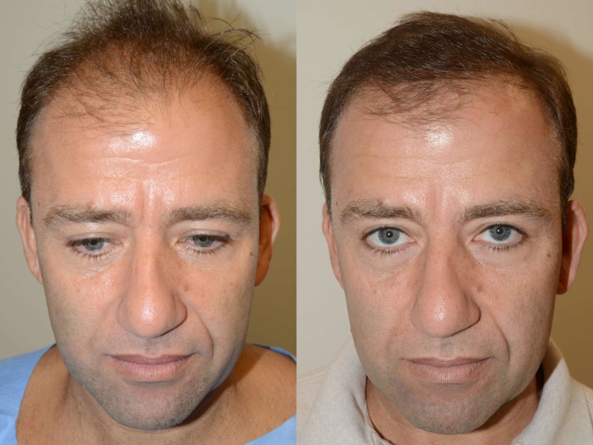 Hair Transplants for Men Before and after in Miami, FL, Paciente 58056