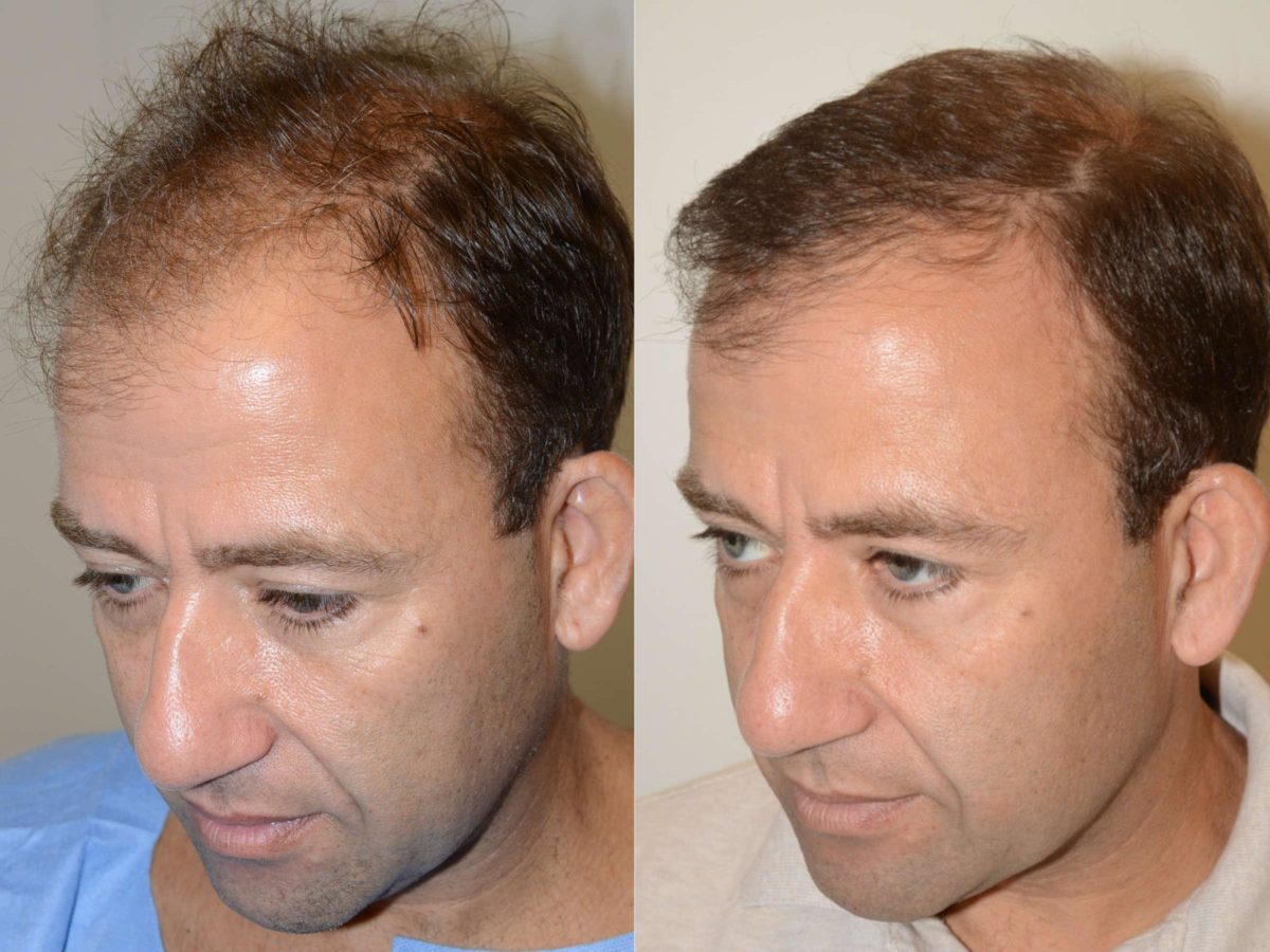 Hair Transplants for Men Before and after in Miami, FL, Paciente 58056