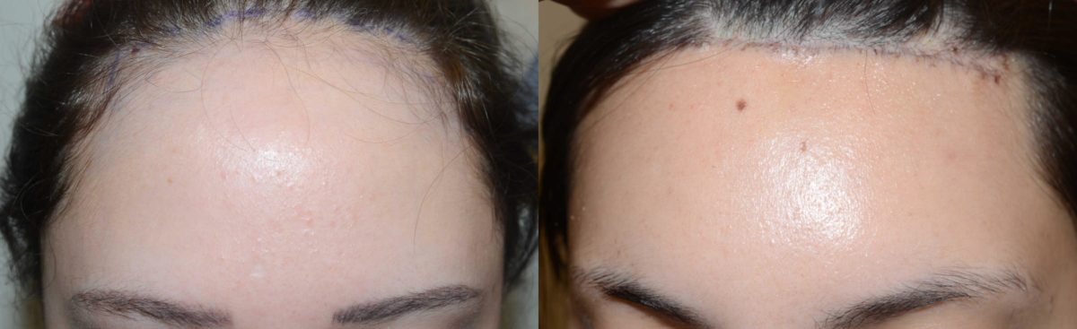 Hairline Advancement Before and after in Miami, FL, Paciente 58083