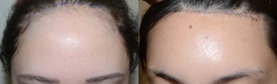Forehead Reduction Surgery Before and after in Miami, FL, Paciente 58083