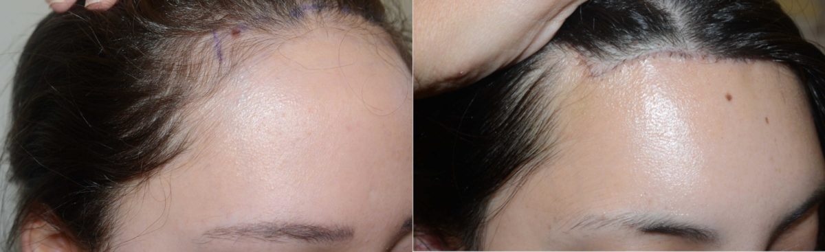 Hairline Advancement Before and after in Miami, FL, Paciente 58083