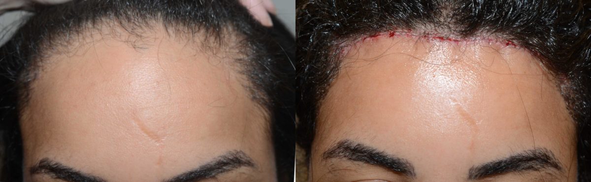 Forehead Reduction Surgery Before and after in Miami, FL, Paciente 58107