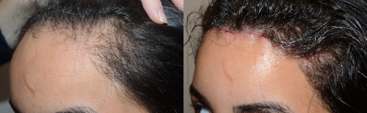 Hairline Advancement Before and after in Miami, FL, Paciente 58107