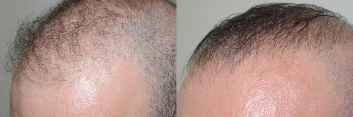 Reparative Before and after in Miami, FL, Paciente 58117