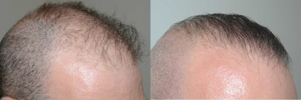 Reparative Before and after in Miami, FL, Paciente 58117