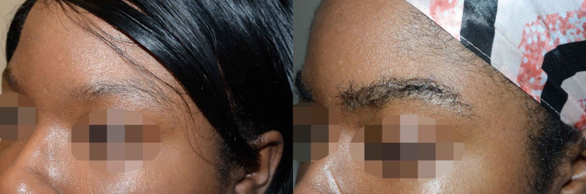 Eyebrow Hair Transplant Before and after in Miami, FL, Paciente 58150