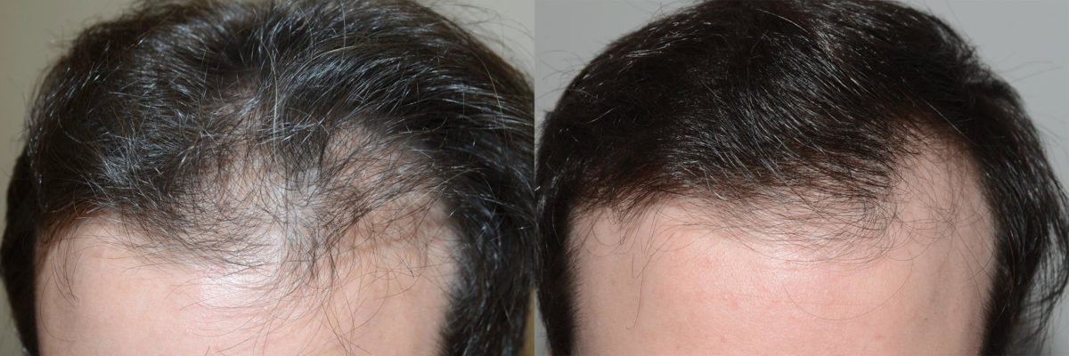 Hair Transplants for Men Before and after in Miami, FL, Paciente 58294