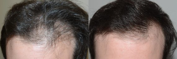 Hair Transplants for Men Before and after in Miami, FL, Paciente 58294