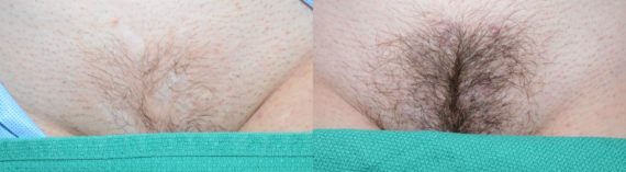 Casos Especiales Before and after in Miami, FL, Paciente 98857