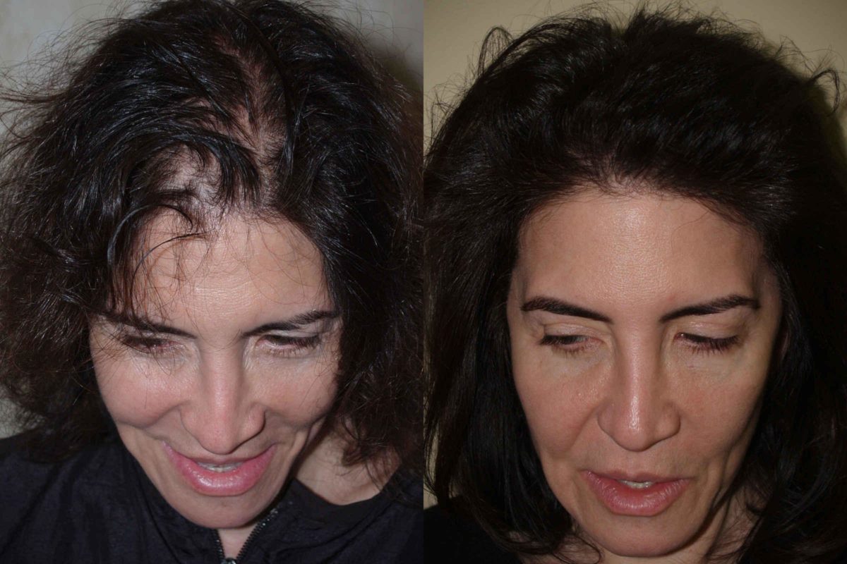 Hair Transplants for Women Before and after in Miami, FL, Paciente 58205