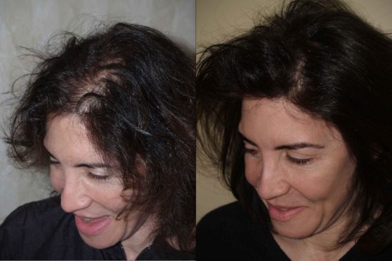 Hair Transplants for Women Before and after in Miami, FL, Paciente 58205