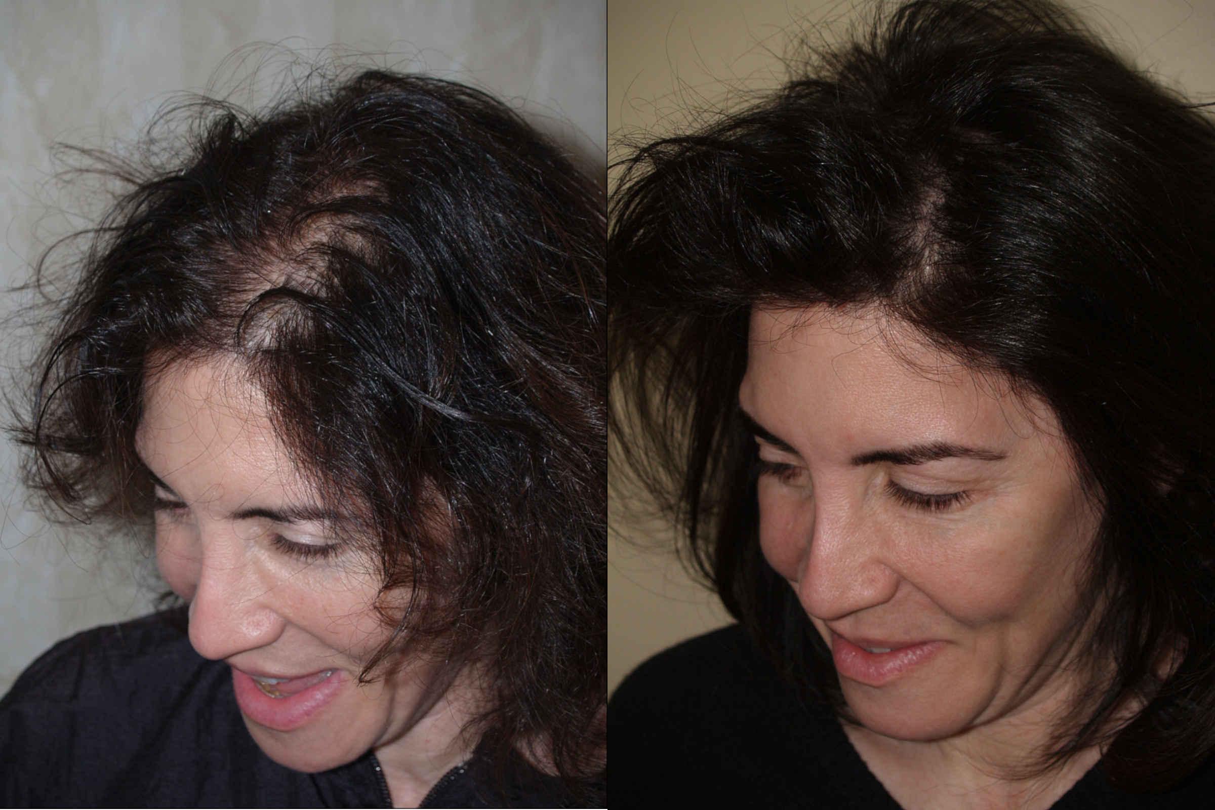 Hair Transplants For Women Photos Miami Fl Patient58205