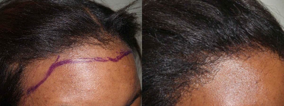 Hair Transplants for Women Before and after in Miami, FL, Paciente 41426