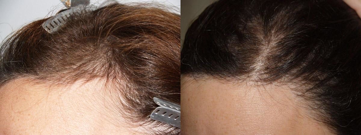 Hair Transplants for Women Before and after in Miami, FL, Paciente 41607