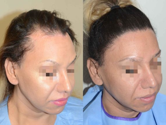 Casos Especiales Before and after in Miami, FL, Paciente 95665