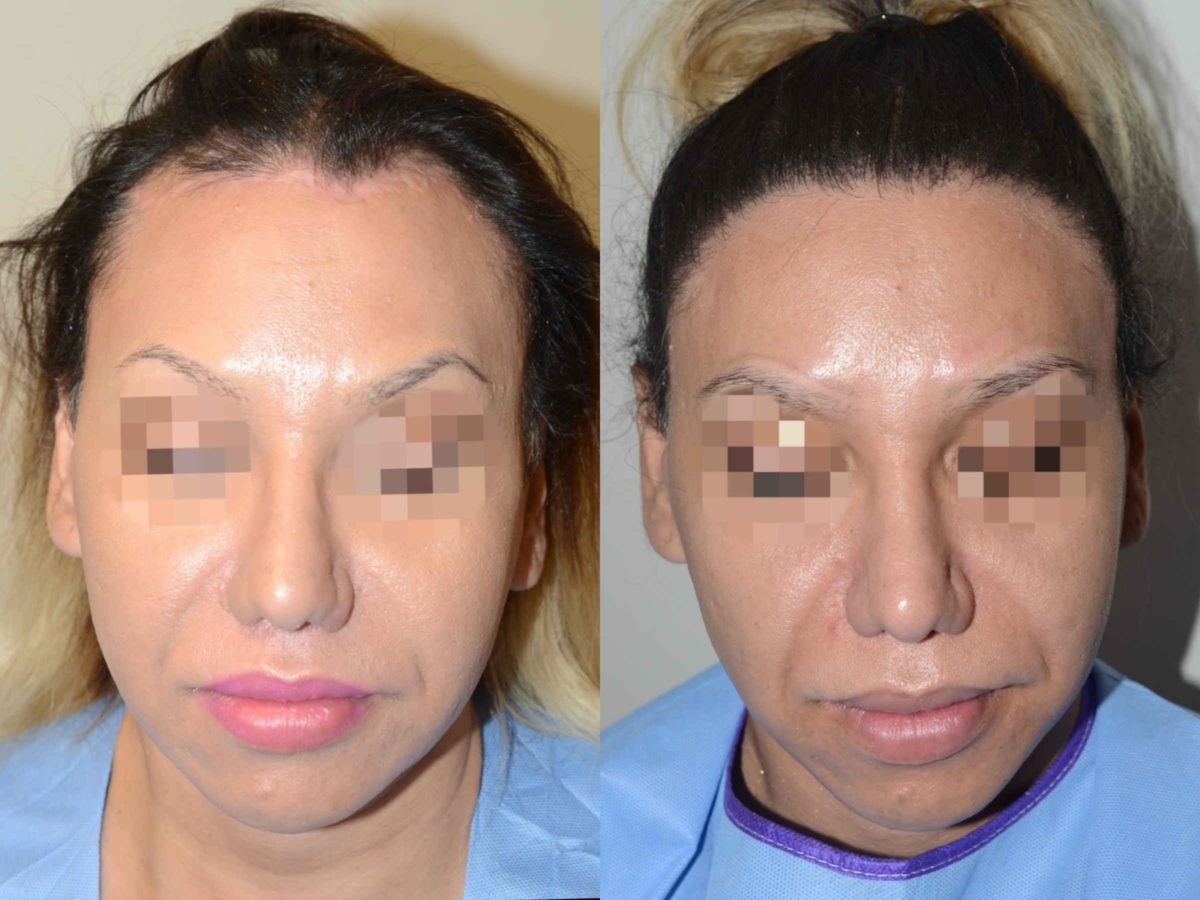 Special Cases Before and after in Miami, FL, Paciente 58185