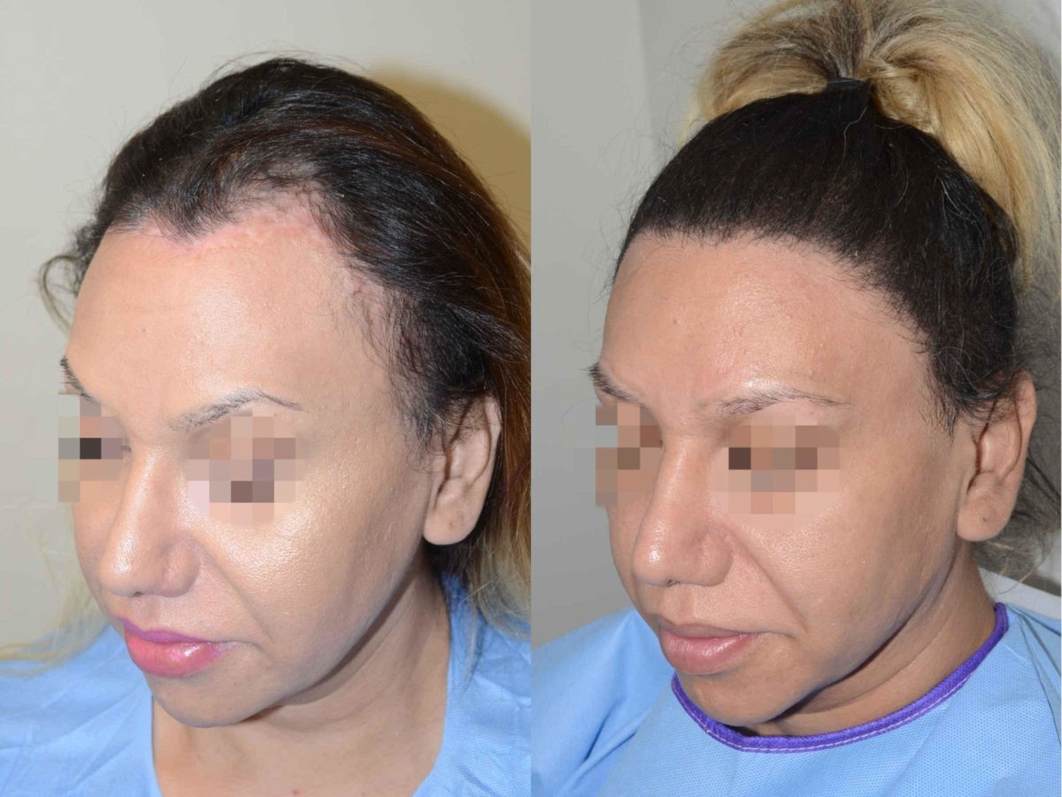 Special Cases Before and after in Miami, FL, Paciente 58185