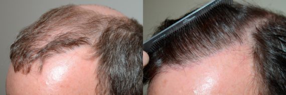 Body Hair Transplant Before and after in Miami, FL, Paciente 58400