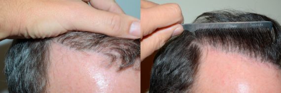 Body Hair Transplant Before and after in Miami, FL, Paciente 58400