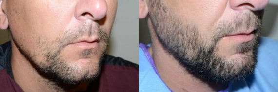 Facial Hair Transplant Before and after in Miami, FL, Paciente 58468