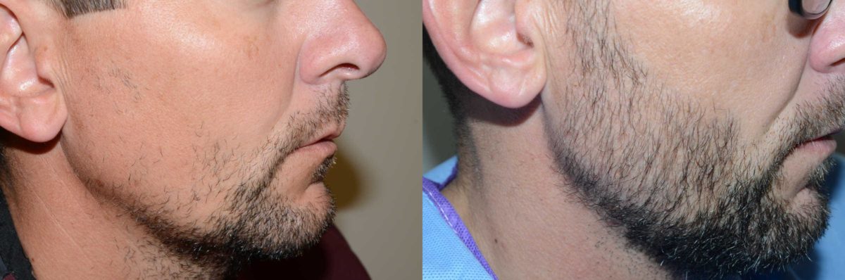 Trasplante de Pelo Facial Antes y después en Miami, FL, Paciente 71078