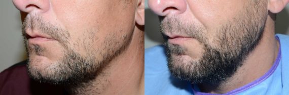 Facial Hair Transplant Before and after in Miami, FL, Paciente 58468