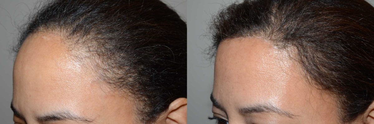 Forehead Reduction Surgery Before and after in Miami, FL, Paciente 58457