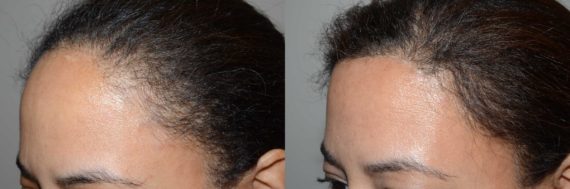 Hairline Advancement Before and after in Miami, FL, Paciente 58457