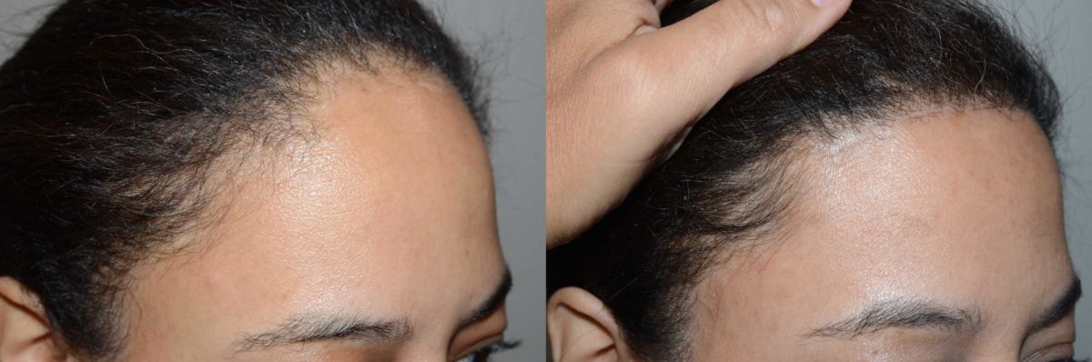 Forehead Reduction Surgery Before and after in Miami, FL, Paciente 58457