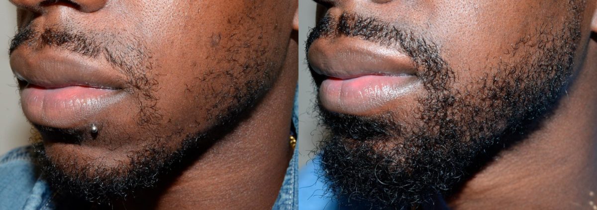Facial Hair Before and after in Miami, FL, Paciente 58603