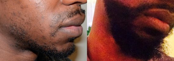 Facial Hair Transplant Before and after in Miami, FL, Paciente 58603